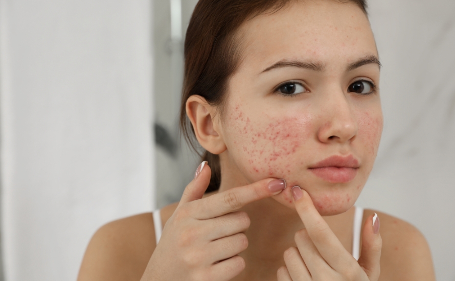 91041-acne-prone-.jpg